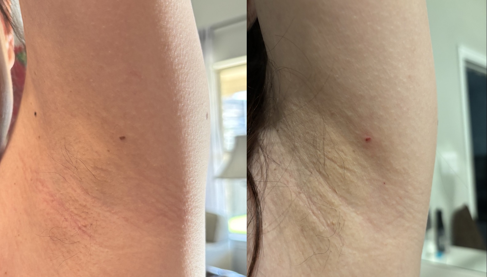 Skin tag fell off
